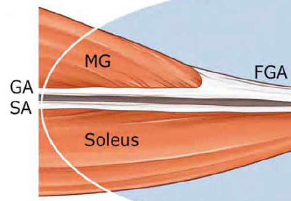Muskel- og aponeuroseskader i triceps surae