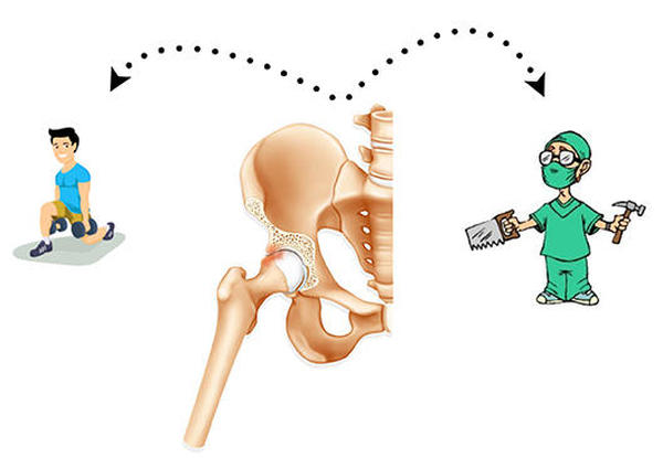 Hofteimpingement: Operasjon eller ikke?